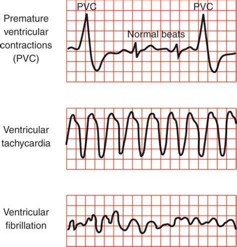 Ventricular Tachycardia Pediatric Diseases And Conditions 5minuteconsult