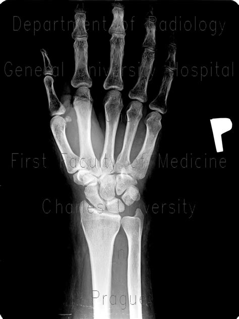 Radiology Case Fracture Of Scaphoid Bone