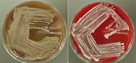 Pathology Outlines Nocardia