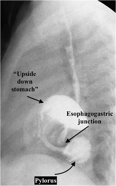 Congenital Paraesophageal Hernia Contemporary Results And Outcomes Of
