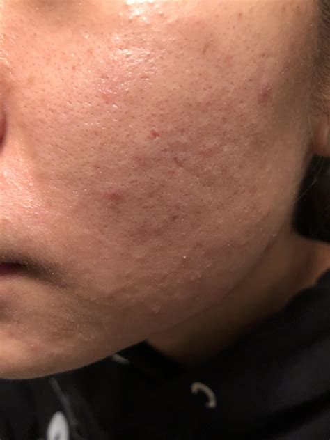Routine Help Oily Skin Bumps And Clogged Pores Oh My Desperate