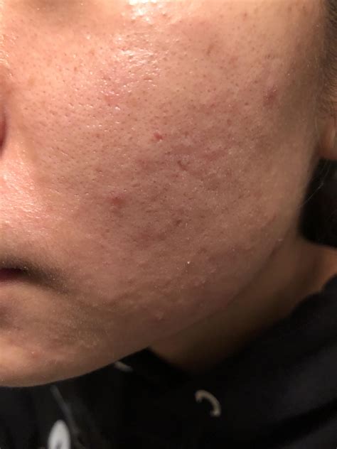 Clogged Pores Bumps