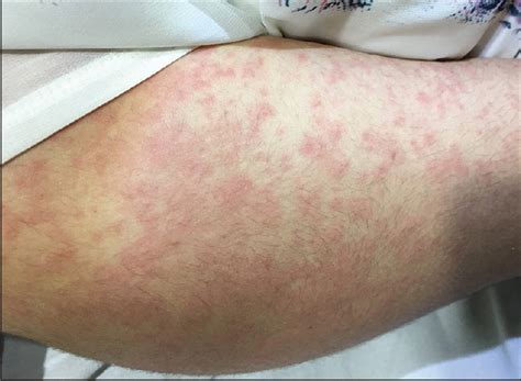 Drug Induced Urticaria Due To Cephalosporins A Case Based Learning