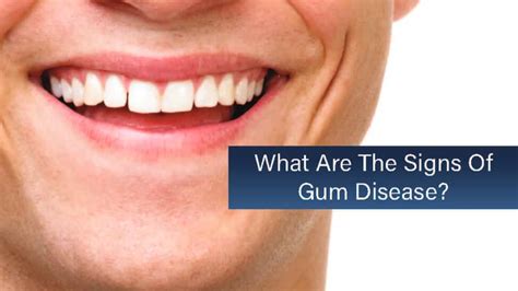 What Are The Signs Of Gum Disease Dawson Dental