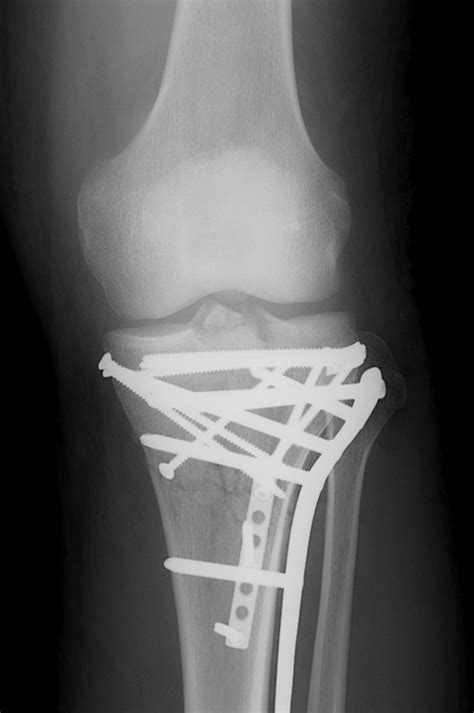 Management And Incidence Of Tibial Tubercle Fractures In Bicondylar