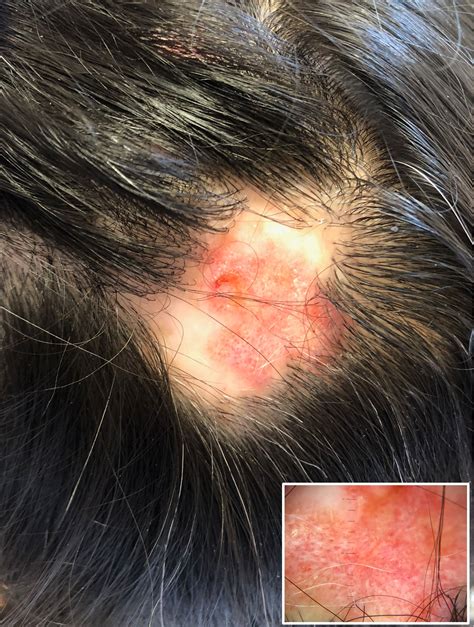 Otras Alopecias Especialista Lupus Discoide Caída De Pelo Por