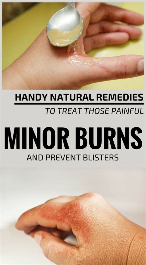 Learn how to treat a rope burn at home, plus when to seek help from. Handy Natural Remedies To Treat Those Painful Minor Burns ...