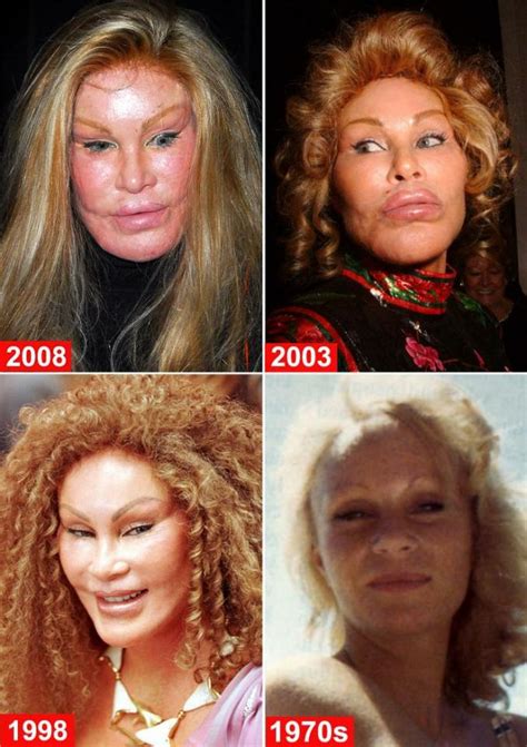 Celebrities Before And After Plastic Surgery Part Musely