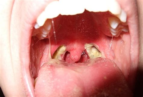 8 Most Common Causes Of White Spots On Throat With Pictures