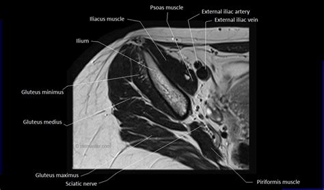 Pectoralis major, pectoralis minor, serratus anterior and subclavius. MRI anatomy of hip joint | free MRI axial hip anatomy