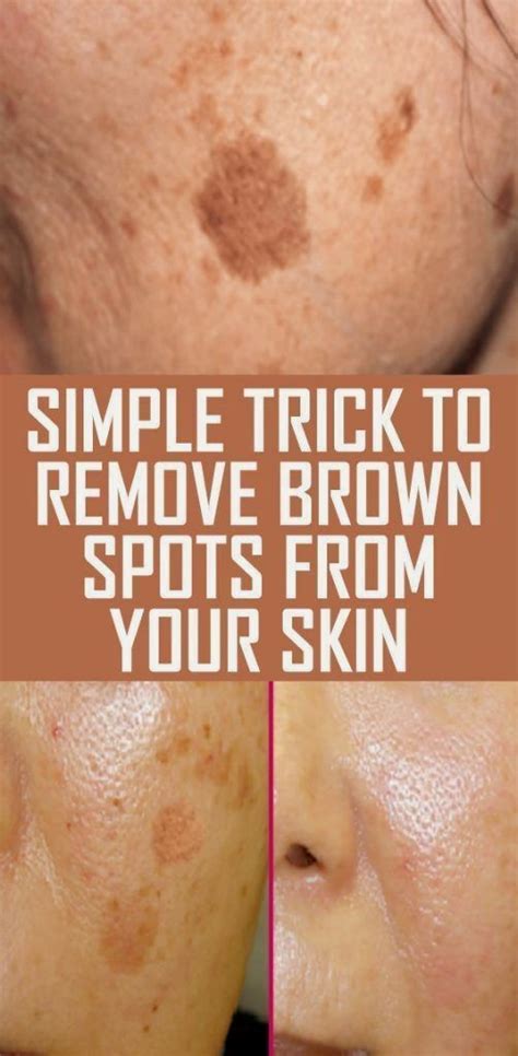 Simple Trick To Remove Brown Spots From Your Skin In 2020 Brown Spots