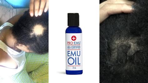 Find out the best emu oil hair growth recipes for your hair type. Emu Oil For Hair Growth? - YouTube