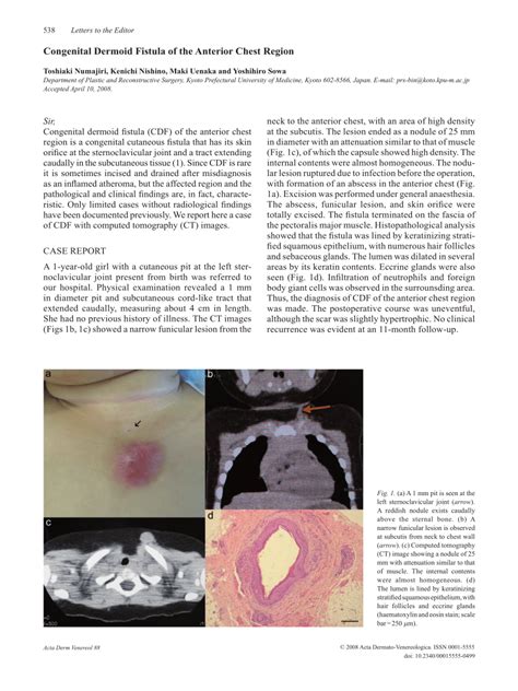 Pdf Congenital Dermoid Fistula Of The Anterior Chest Region