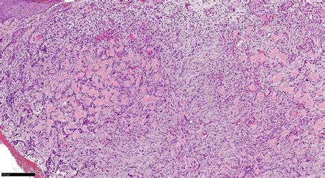 Morpheaform Basal Cell Carcinoma Histology