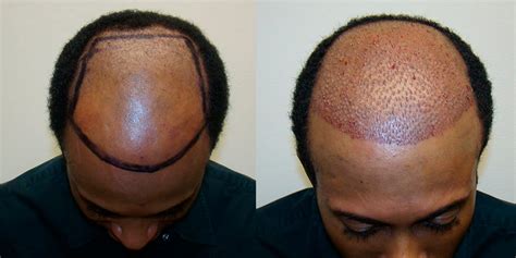 Nht medical center uses its unique. Hair Transplant On African American Male With Shaved Head ...