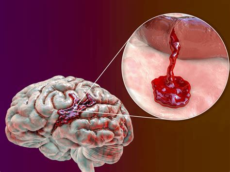Síntomas que produce el sangrado en el interior del cerebro