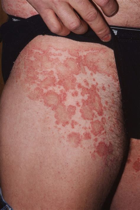 Pityriasis Rosea Pictures Stages Causes Treatment Causes Images