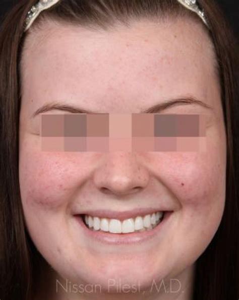 Acne Treatments Irvine Clear Skin Orange County Total Dermatology