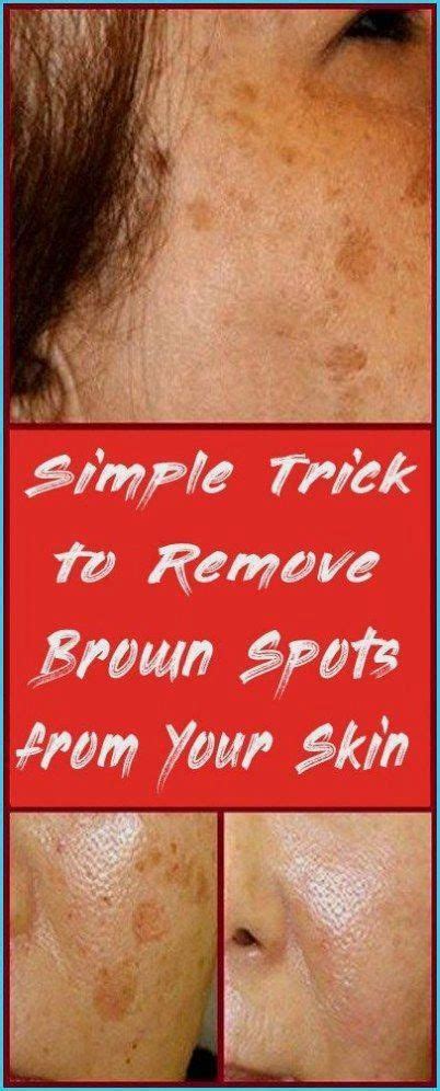 Simple Trick To Remove Brown Spots From Your Skin In 2020 Skin Herbal