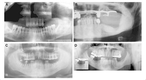 Panoramic Radiology Of Osteonecrosis Of The Jaw A Classic Lytic Bone