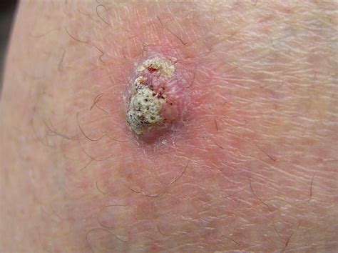 What Is Squamous Cell Carcinoma
