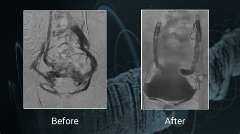 Video Pelvic Congestion Syndrome Embolization With Coils And Glue