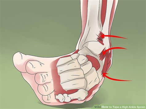How To Tape A High Ankle Sprain With Pictures Wikihow