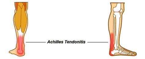 Top Facts About Achilles Tendon Pain Tendonitis And Achilles Rupture