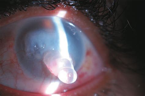 Left Eye Of The Patient Note The Edematous And Opaque Cornea And The