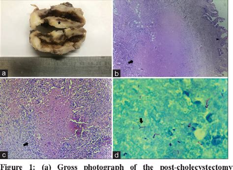 Gallbladder Tuberculosis A Rare Case Report With Review Of Literature