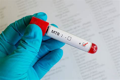 Tuberculosis Testing Stock Photos Pictures And Royalty Free Images Istock