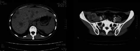 Abdominal Computerized Tomography Scan Left Multiple Liver