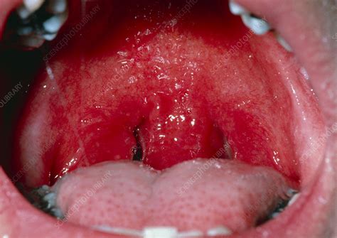 Throat Infection Streptococcal Pharnygitis Stock Image M1650124