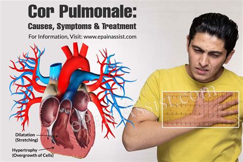 Cor Pulmonale Causes Symptoms And Treatment