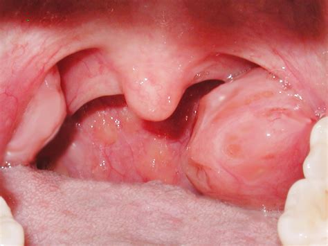 One Tonsil Larger Than The Other A Sign Of Cancer Fauquier Ent Blog