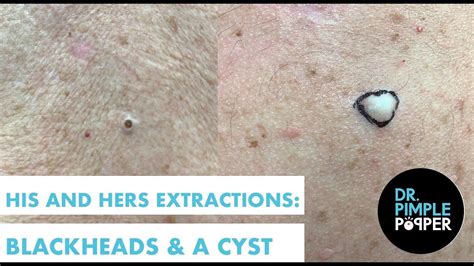 His And Hers Extractions Blackheads And A Cyst Youtube Blackheads