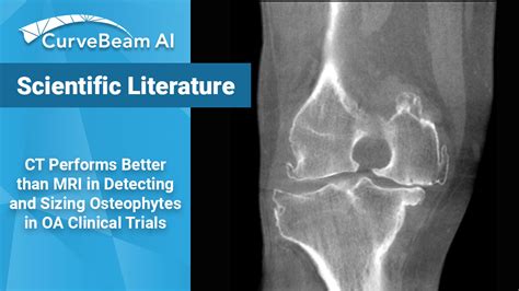 Ct Outperforms Mri In Osteophyte Detection In Knees Curvebeam Ai