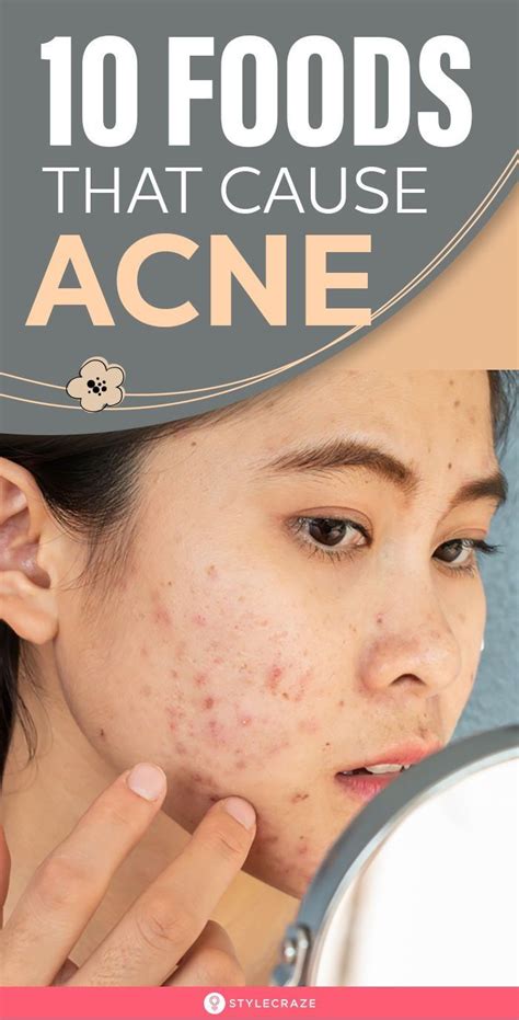 Top 10 Foods That Cause Acne Life Style