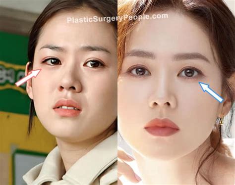 Son Ye Jin Before And After