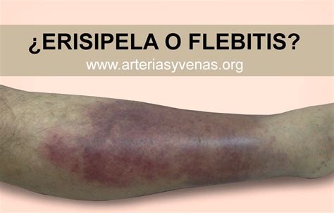 Erisipela O Flebitis Arterias Y Venas Part 3