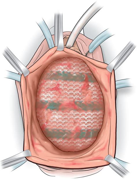 Early Experience With Mesh Excision For Adverse Outcomes After Transvaginal Mesh Placement Using