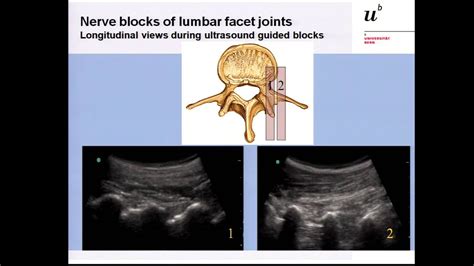Lumbar Medial Branch Nerve Block