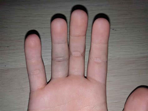 Jammed Finger Causes Symptoms And Jammed Finger Treatment