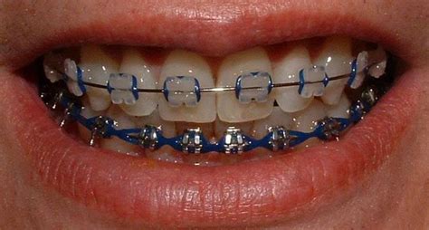 The Best Braces Color Ideas For Spring 2022