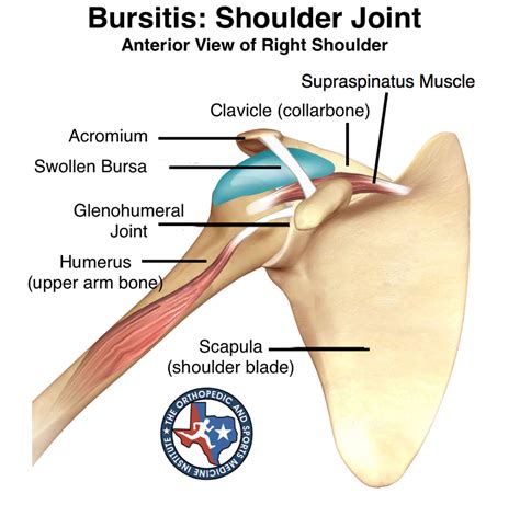 Bursitis Shoulder Joint The Orthopedic And Sports Medicine Institute In