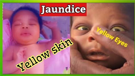 Sign Of Jaundice Newborn Baby How To Treat Jaundice In Baby At Home