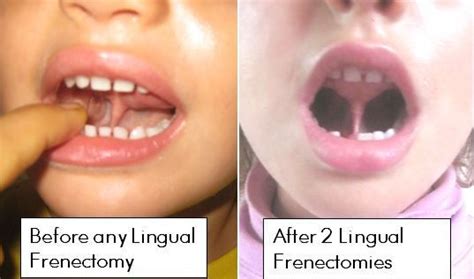 Lingual Frenectomy Before After Tongue Tie Oral Surgeon Skin Brushing