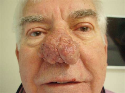 shocking before pictures show how rare condition made man s nose grow so big he could barely see