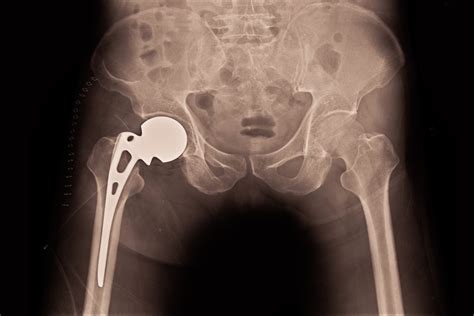 Why Do Men And Women Fare Differently After Hip Replacement Surgery