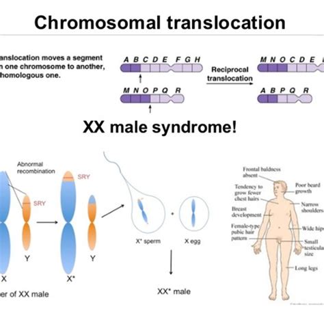 Achilles Heel In Y Chromosome Linked To Sex Disorders Hot Sex Picture